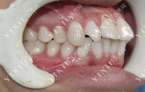 牙齿畸形突嘴形态示意图
