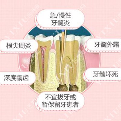 牙齿根管治疗改善图