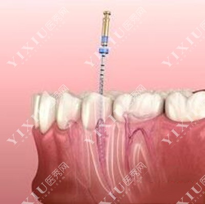 根管治疗改善展示图