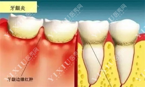 牙周炎内部展示图