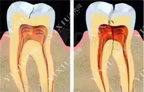 牙髓内部坏死图