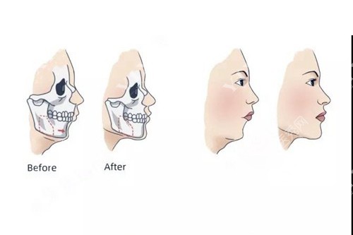 骨性牙齿畸形治疗前后对比示意图