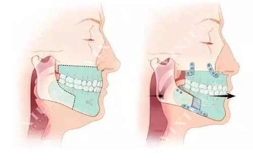 正颌手术前后对比解剖示意图