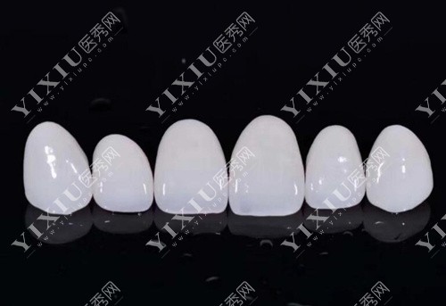 全瓷贴面产品图