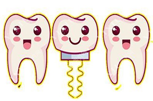 固定义齿换成种植牙我后悔了!进来看我的缺牙修复经历(图3) 固定义齿换成种植牙我后悔了!进来看我的缺牙修复经历(图3)