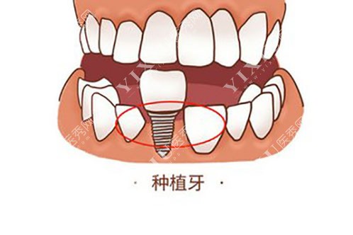 牙齿种植卡通示意图