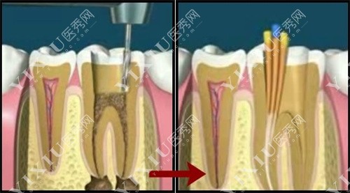 根管治疗过程图