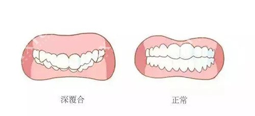牙齿咬合深覆合和正常示意图