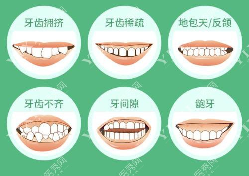 牙齿畸形形态示意图