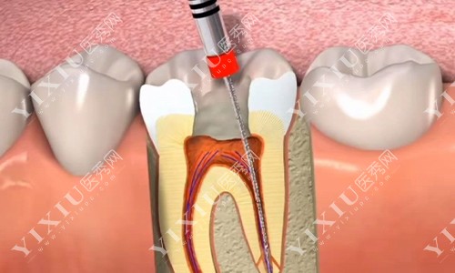根管治疗示意图