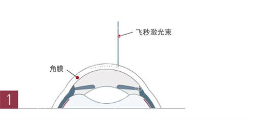 飞秒激光手术示意图