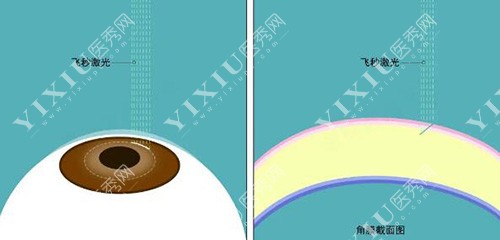 飞秒近视眼手术诊疗展示