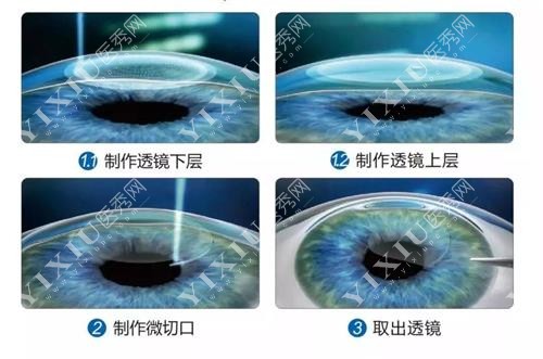 飞秒手术过程示意图