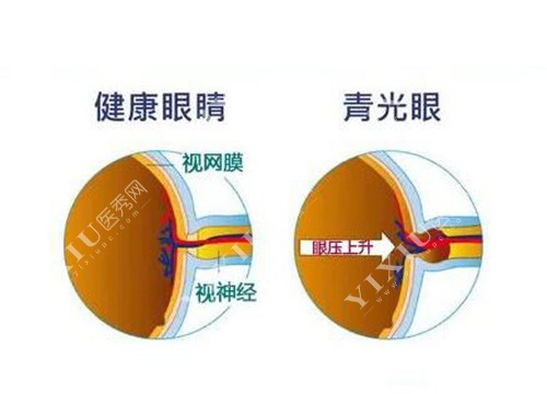 健康眼睛和青光眼对比