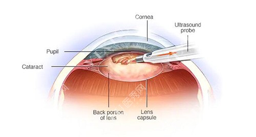 眼睛手术改善图