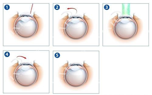 激光近视眼手术过程示意图