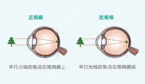 正常眼和近视眼对比示意图