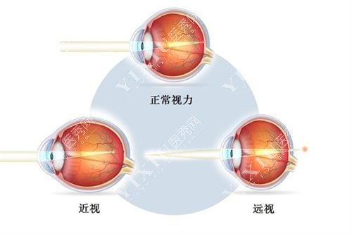 正常近视远视三种区别