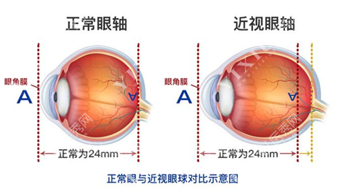 正常眼睛和近视眼镜眼轴