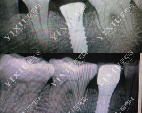 种植牙植体CT图片