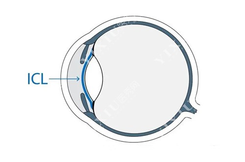 ICL晶体植入位置示意图