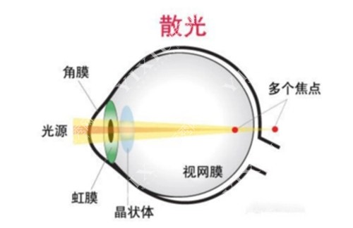 散光导致视野不清晰原因示意图