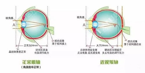 近视眼和正常眼球区别