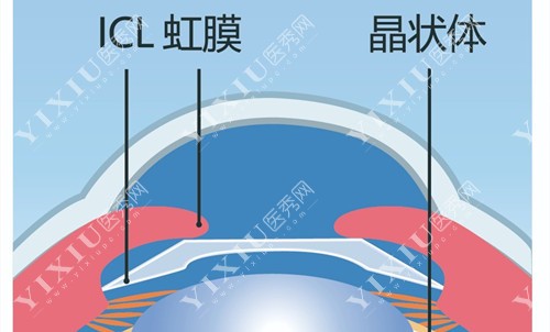 ICL晶体植入位置示意图