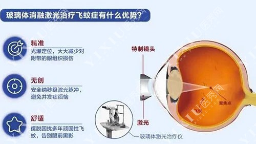 激光玻璃体消融术治疗飞蚊症原理