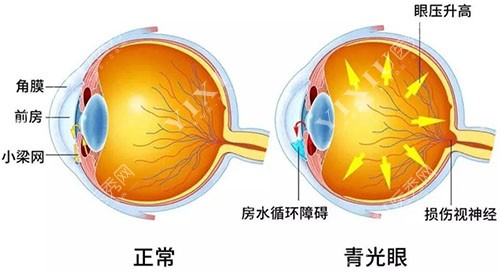 青光眼和正常眼睛对比