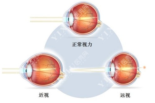 正常视力、近视、远视概念图