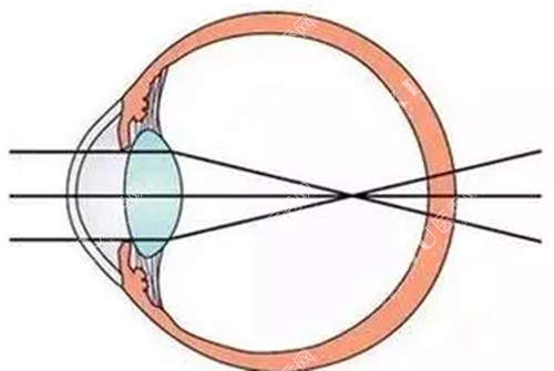 近视眼睛眼球成像原理