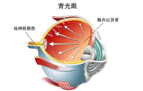 青光眼卡通示意图