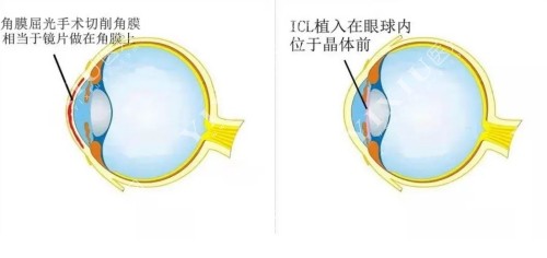  ICL晶体植入与飞秒的区别