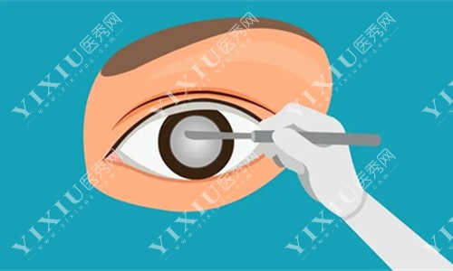 卡通眼睛手术图