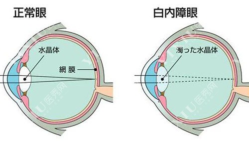 正常眼睛和白内障的区别