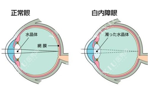 正常眼与白内障对比