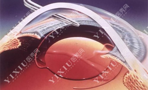 河北保定德仁眼科怎么样？高碑店价格优惠，眼科手术项目全！(图5)