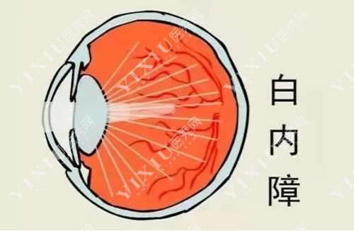 白内障原理图