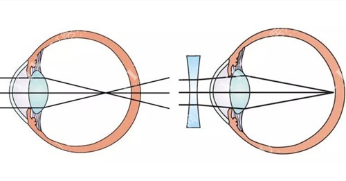 近视镜工作原理示意图