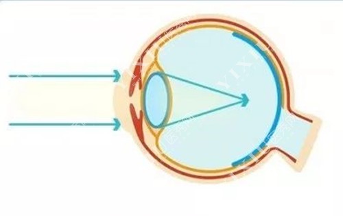 不干预的近视成像示意图
