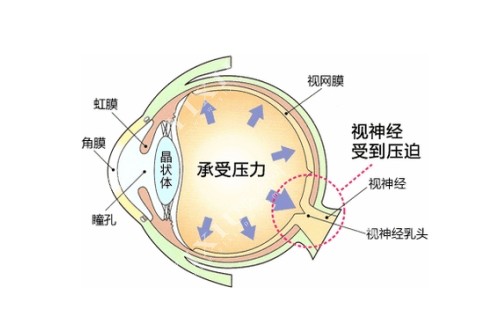 眼压高概念图片展示