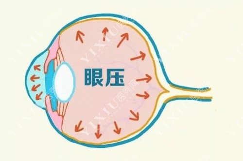 眼压升高卡通图片展示