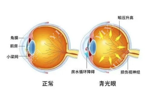 正常眼睛和青光眼概念图片展示