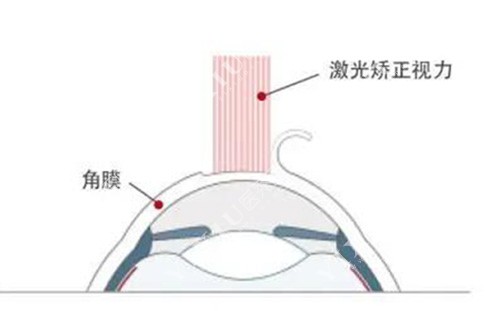 激光近视改善方式