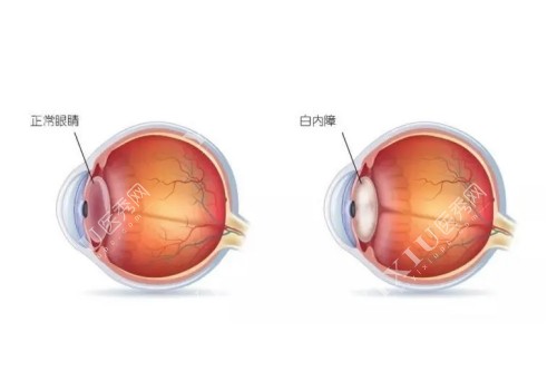 正常眼睛和白内障眼睛卡通对比图