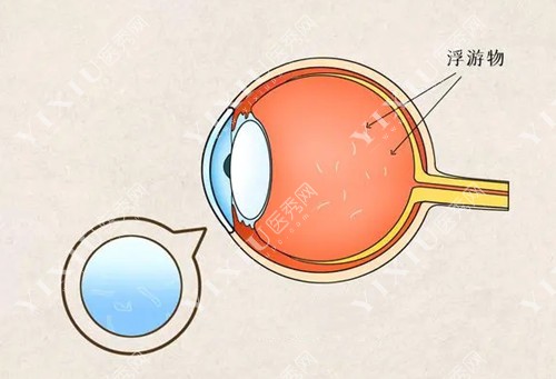 飞蚊症眼球结构
