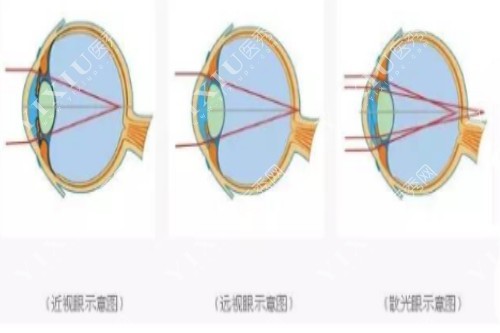 近视、远视、散光示意图