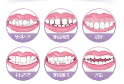 牙齿畸形示意图