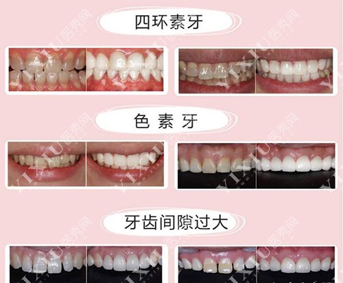 各种牙齿需要美白的形态